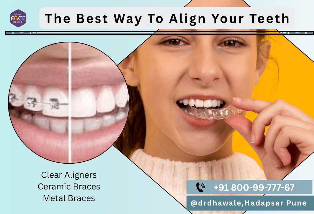Aligners, Clear Braces, Braces, Orthodontics