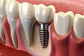 Dental Implant For Teeth Replacement Dr Dhawale Hadapsar Pune