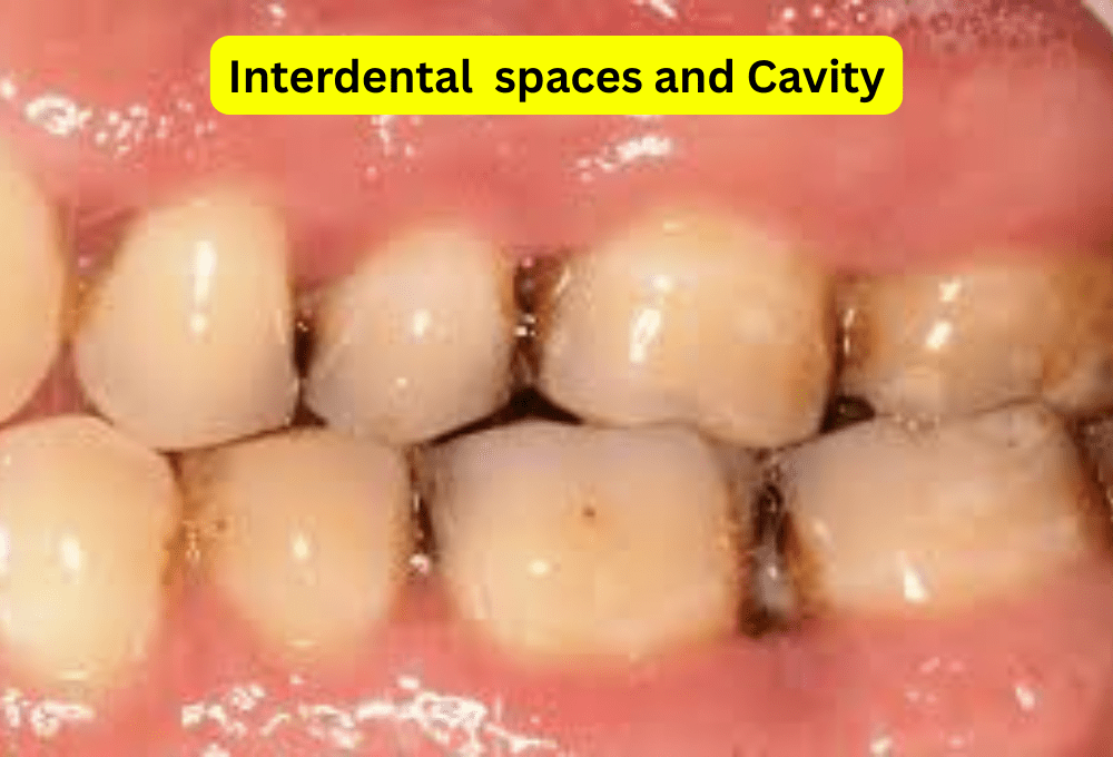 Dental-Cavity-Dentist -Pune