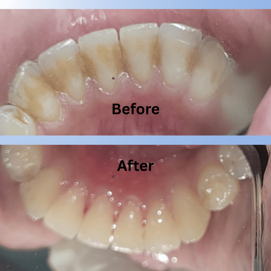 Best-Dentist -Before-After- Cleaning-Pune